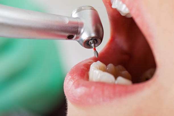 Best Lost Filling or Crown Replacement in La Habra, CA